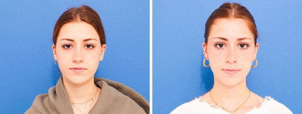 Before and After Image: Rhinoplasty - front