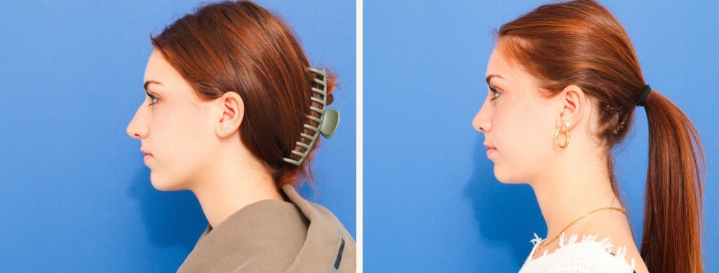 Before and After Image: Rhinoplasty - left-side