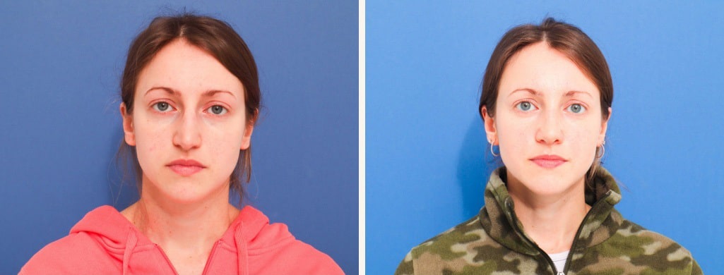 Before and After Image: Rhinoplasty - front