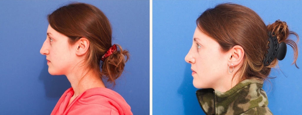 Before and After Image: Rhinoplasty - left-side