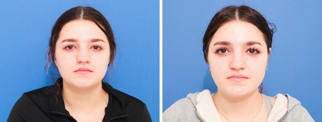 Before and After Image: Rhinoplasty - front