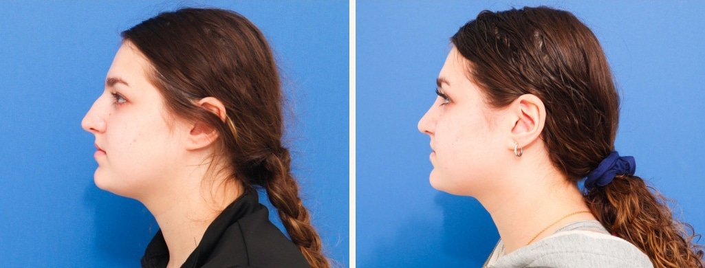 Before and After Image: Rhinoplasty - left-side