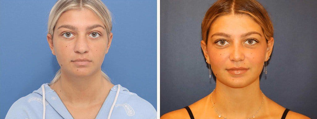 Before and After Image: Rhinoplasty - front