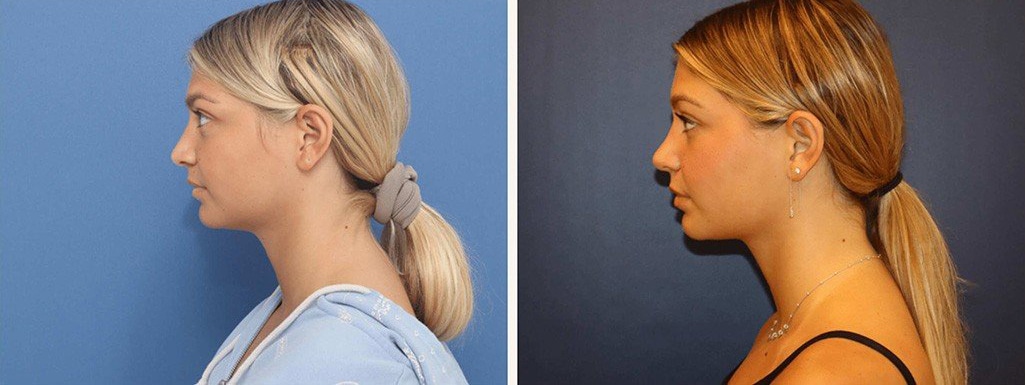 Before and After Image: Rhinoplasty - left-side