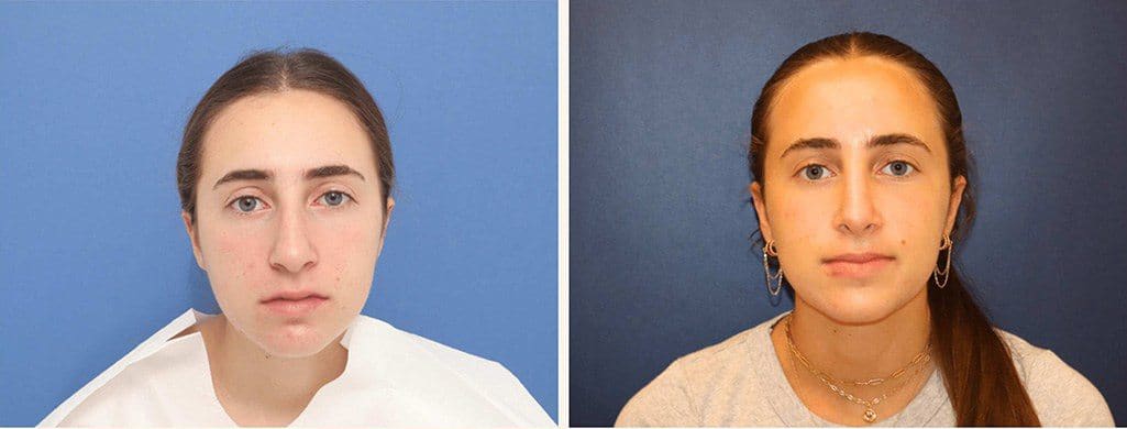 Before and After Image: Rhinoplasty - front