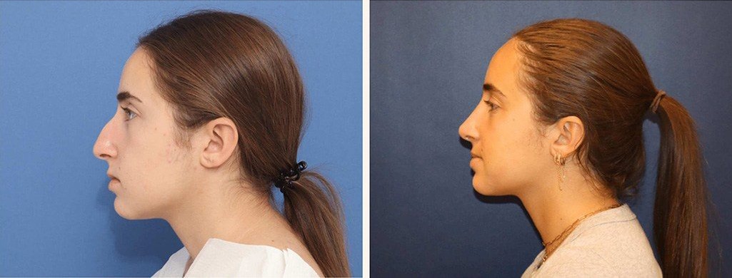 Before and After Image: Rhinoplasty - left-side