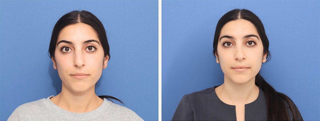 Before and After Image: Rhinoplasty - front