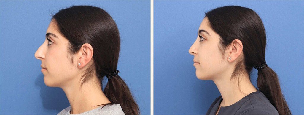 Before and After Image: Rhinoplasty - left-side
