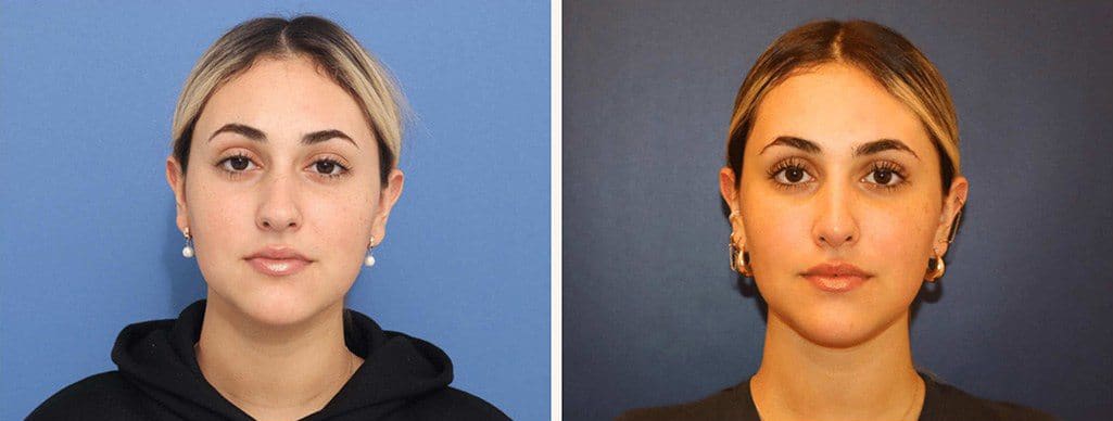 Before and After Image: Rhinoplasty - front