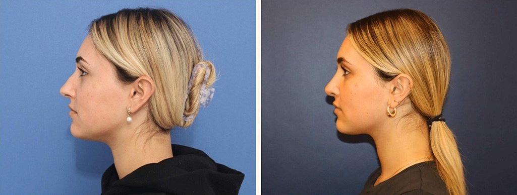 Before and After Image: Rhinoplasty - left-side