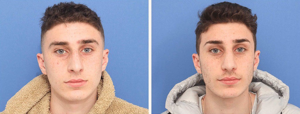 Before and After Image: Rhinoplasty - front