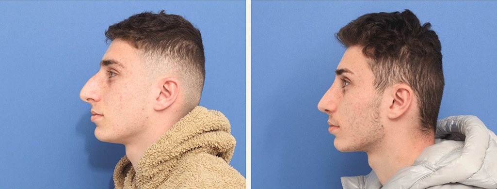 Before and After Image: Rhinoplasty - left-side
