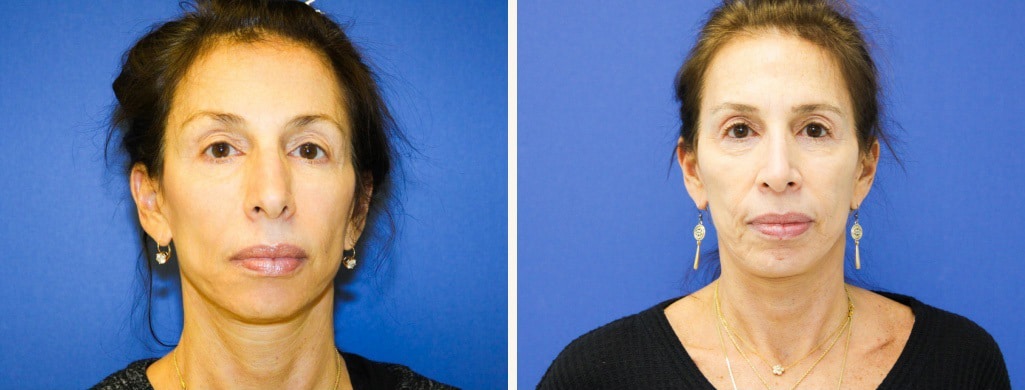Before and After Image: Rhinoplasty - front
