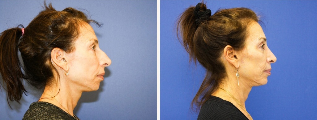Before and After Image: Rhinoplasty - right-side