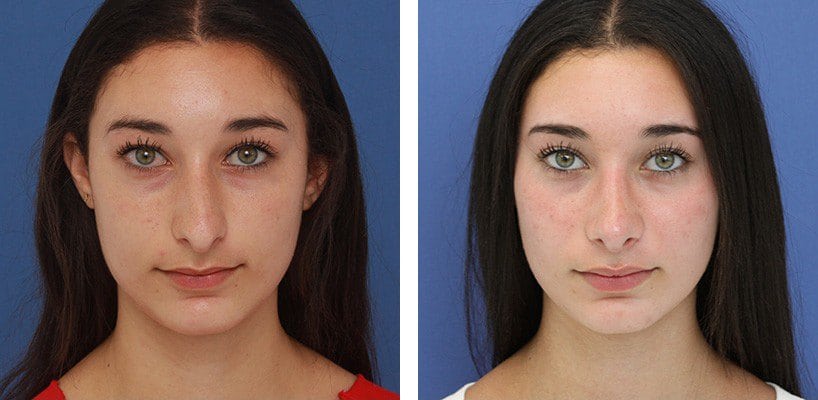 Before and After Image: Rhinoplasty - front