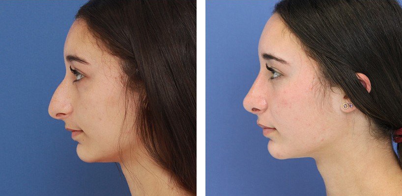 Before and After Image: Rhinoplasty - left-side