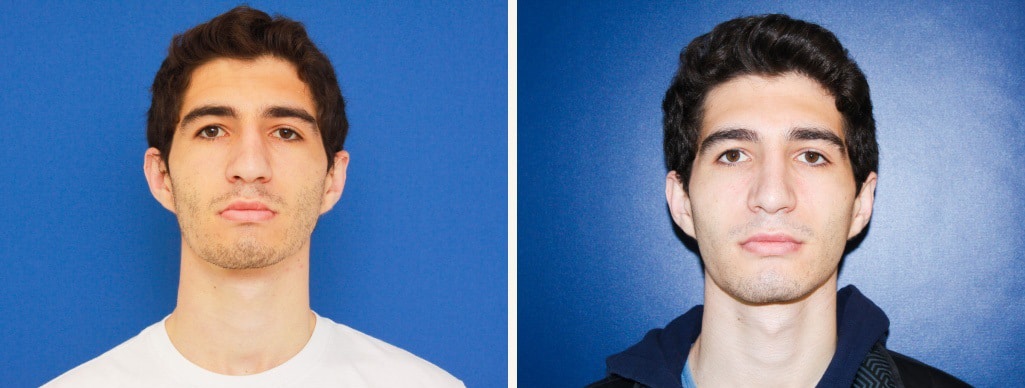 Before and After Image: Rhinoplasty - front