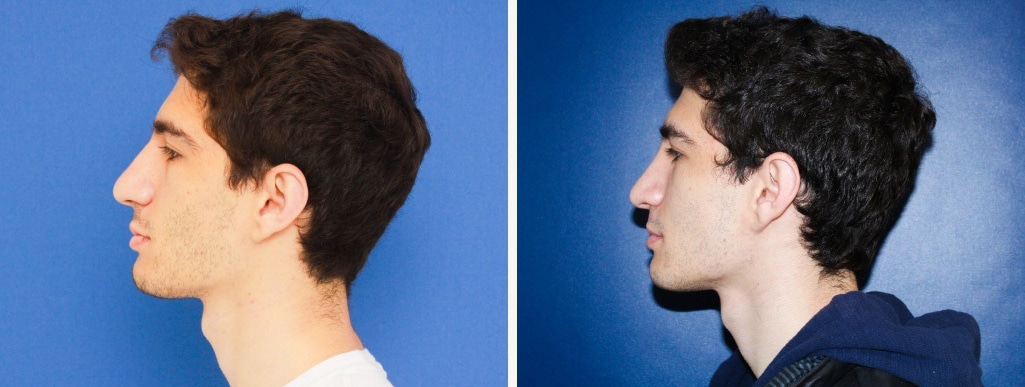 Before and After Image: Rhinoplasty - left-side