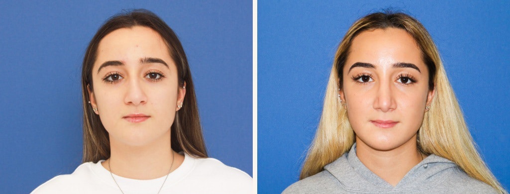 Before and After Image: Rhinoplasty - front