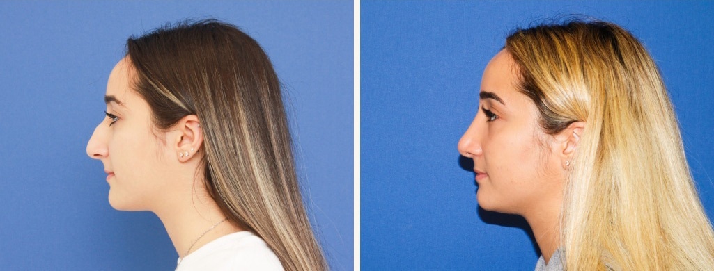 Before and After Image: Rhinoplasty - left-side