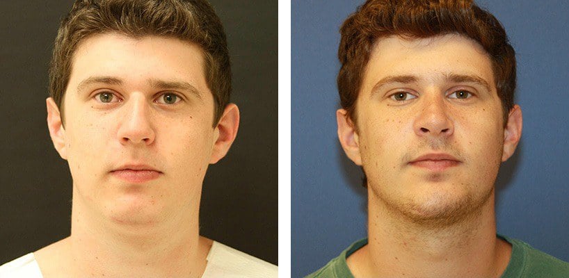 Before and After Image: Rhinoplasty - front