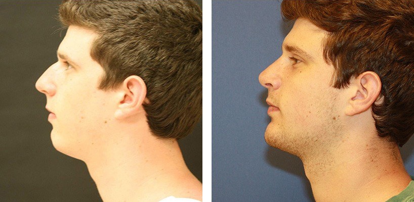 Before and After Image: Rhinoplasty - left-side