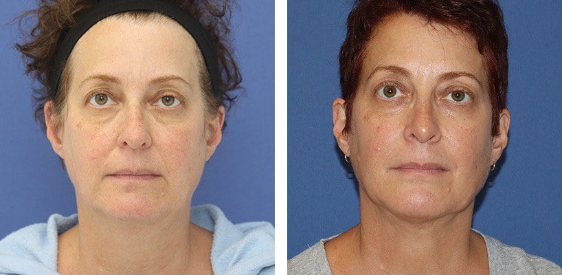 Before and After Image: Rhinoplasty - front
