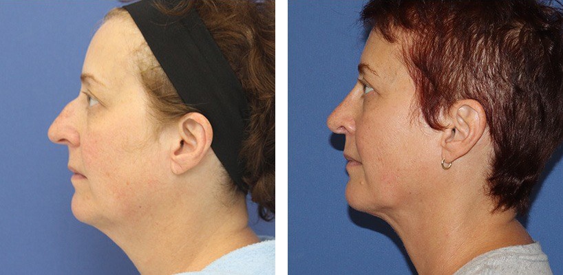 Before and After Image: Rhinoplasty - left-side