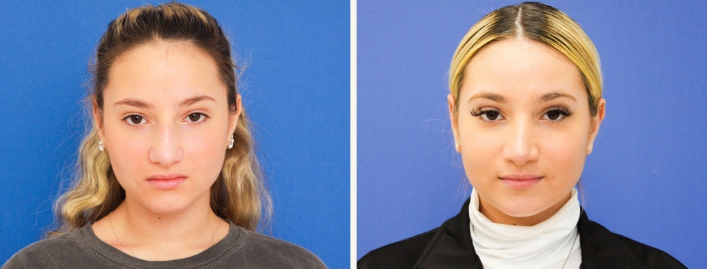 Before and After Image: Rhinoplasty - front