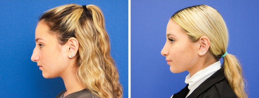 Before and After Image: Rhinoplasty - left-side