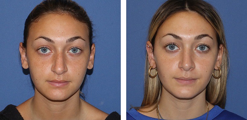 Before and After Image: Rhinoplasty - front