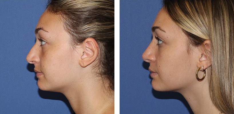 Before and After Image: Rhinoplasty - left-side