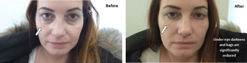 Before and After Image: Fillers & Toxins - front