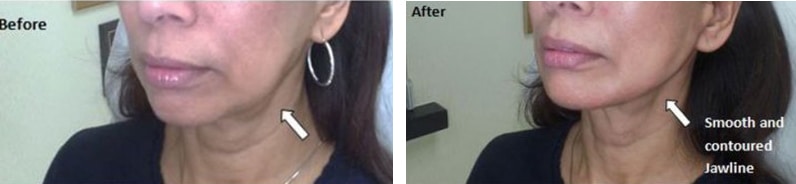 Before and After Image: Fillers & Toxins - left-front-oblique