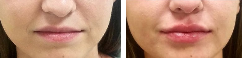 Before and After Image: Fillers & Toxins - front
