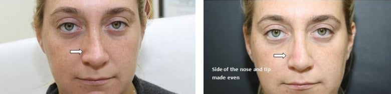 Before and After Image: Fillers & Toxins - front