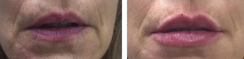 Before and After Image: Fillers & Toxins - front