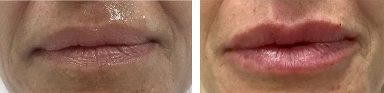 Before and After Image: Fillers & Toxins - front
