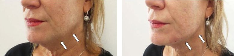 Before and After Image: Fillers & Toxins - left-front-oblique