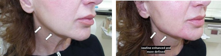 Before and After Image: Fillers & Toxins - right-front-oblique