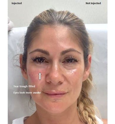 Before and After Image: Fillers & Toxins - front