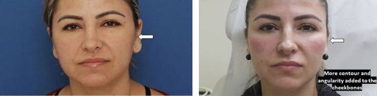 Before and After Image: Fillers & Toxins - front