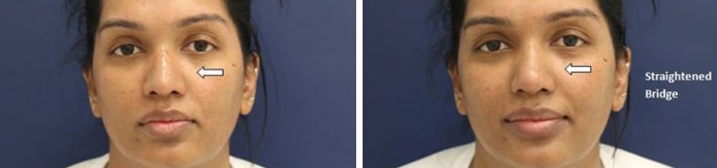Before and After Image: Fillers & Toxins - front