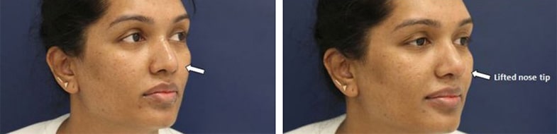 Before and After Image: Fillers & Toxins - right-front-oblique