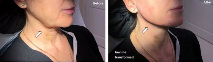 Before and After Image: Fillers & Toxins - right-front-oblique