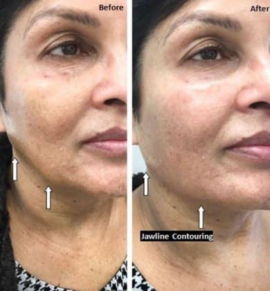 Before and After Image: Fillers & Toxins - right-front-oblique