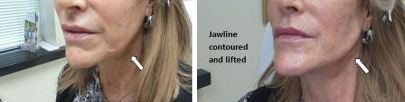 Before and After Image: Fillers & Toxins - left-front-oblique