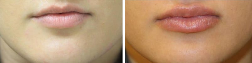 Before and After Image: Fillers & Toxins - front