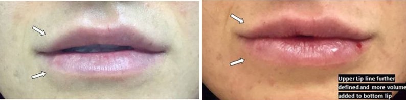 Before and After Image: Fillers & Toxins - front