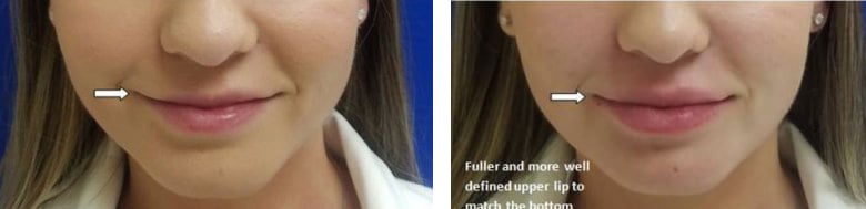 Before and After Image: Fillers & Toxins - front